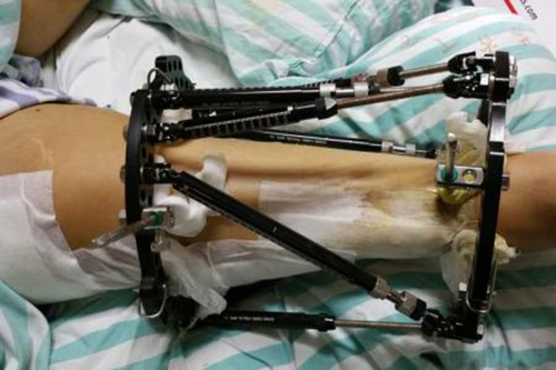 碳纤维医疗支架比金属支架的实用性高吗?