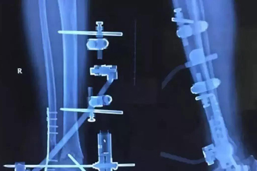 为什么碳纤维人工骨可植入人体?